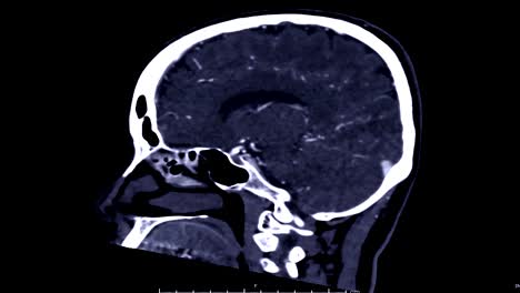 CTA-Gehirn-Sagittalebene.
