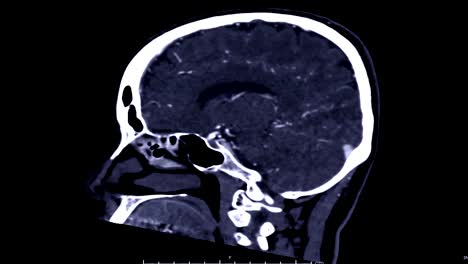 CTA-cerebro-sagital.