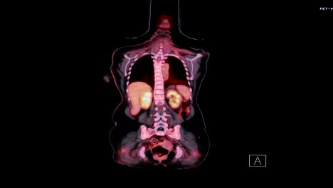 Imagen-de-PET-CT-de-cuerpo-entero-en-el-plano-Coronal.-Tomografía-por-emisión-de-positrones---tomografía-computarizada.