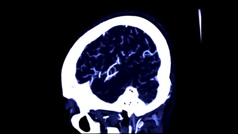 CTA-cerebral-o-angiografía-tomográfica-computada-de-la-vista-sagital-del-cerebro-/-3D-Rendering-buques-de-proyección-de-imagen-en-cerebro-humano.