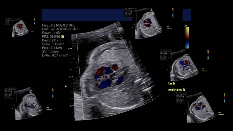 Fetal-echocardiogram