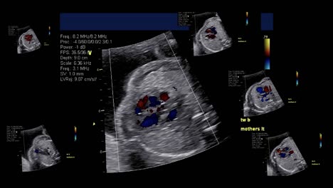 Ecocardiografía-fetal