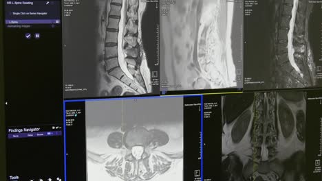 Spinal-cord-and-spinal-column-tomography-on-MRI-scan.