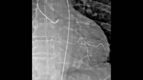 Cardiovascular-angiography