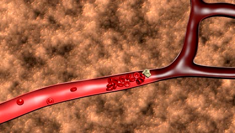 Animation-of-the-formation-of-thrombosis