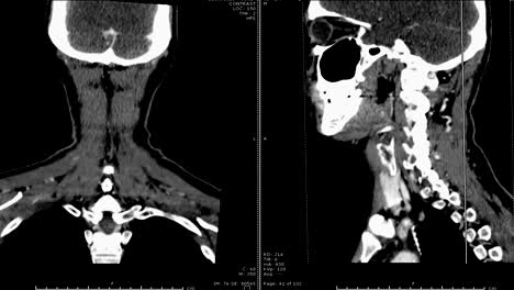 CT-Scan-des-Halsbereiches.