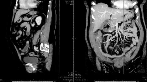 CT-whole-abdomen-sagittal-vs-coronal--view-.