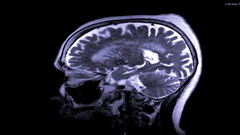 MRI-of-the-brain-in-sagittal--plane-with-contrast-media-.magnetic-resonance-imaging-of-the-brain.