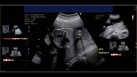 Ecocardiografía-fetal