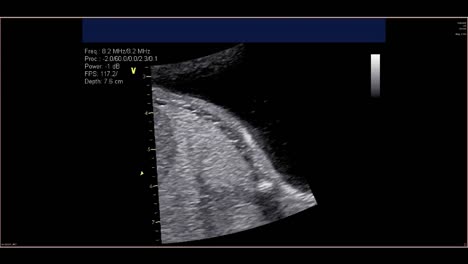 Fetal-echocardiogram