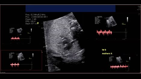 Ecocardiografía-fetal