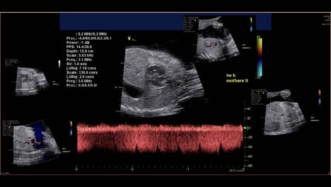 Fetal-echocardiogram