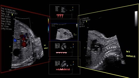 Fetal-echocardiogram