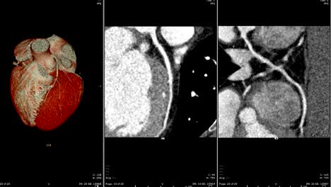 Muiti-view-of-CTA-Coronary-artery-2D-and-3D-rendering.-CT-angiographphy-for-heart-disease-.-Technology-Concept.