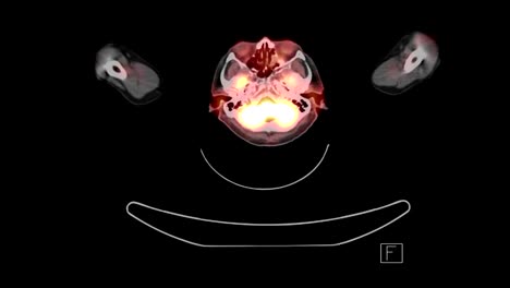 Computertomographie-(PET/CT)-der-ganze-Körper-axiale-Ansicht.