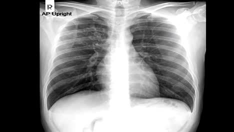 Zoom-im-Röntgenbild-der-menschlichen-Brust---Tuberkulose-(TB)-Screening.