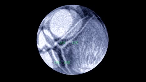 Retrospektiven-CT-Angiographie-koronaren-Arterie-sehen-aus-wie-die-Erde-drehen-auf-dem-Bildschirm-mit-anatomischen-des-Herzens.