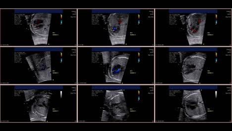 Ecocardiografía-fetal