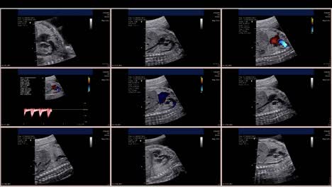 Fetal-echocardiogram