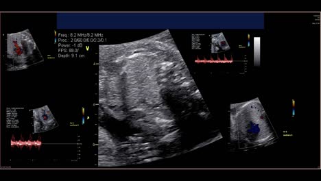 Fetal-echocardiogram