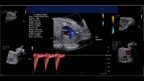 Fetal-echocardiogram