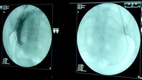 Alive-female-chest-on-a-circular-blue-screen-of-a-modern-X-ray-appliance