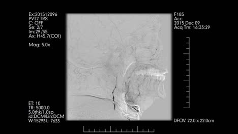 Grauen-farbigen-Gehirn-Schiffe-Angiographie-Datenmonitor.