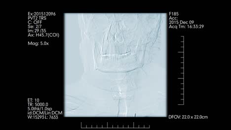 Zerebrale-Angiographie-Überwachung.-Ansicht-von-vorne.