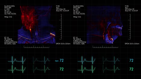 Medical-display-with-two-brain-vessel-angiograms-on-it