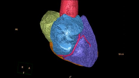 Rotierende-Ansicht-des-CTA-(Computertomographie-topographische-Angiographie)-Koronararterie