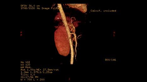 Angiografía-de-CT-del-tronco-celíaco-con-renderizado-3D-de-riñón.