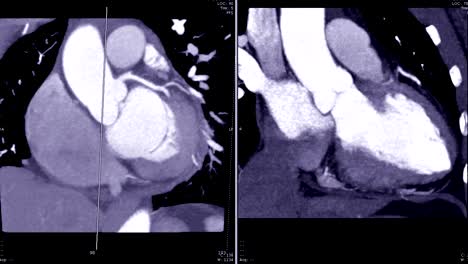CT-Angiographie-(CTA)-der-Koronararterien-koronalen-Schrägansicht-mit-MIP-Technik-zeigen-anatomische-des-Herzens.