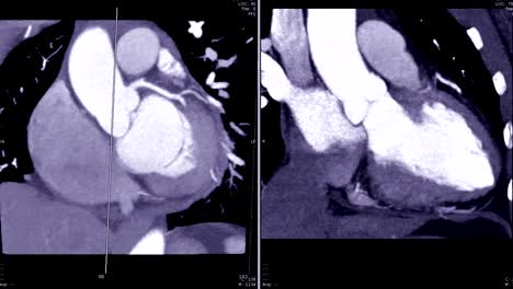 La-angiografía-de-CT-(CTA)-de-vista-coronaria-Coronal-oblicua-con-técnica-MIP-mostrando-anatómica-del-corazón.