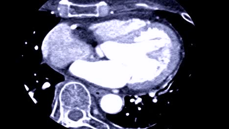 CTA-of-Coronary-artery-in-Axial-view.