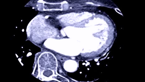 CTA-de-coronaria-arteria-en-la-vista-Axial.