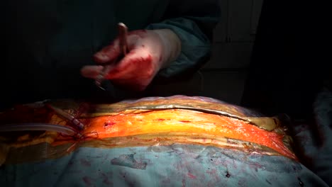 Arzt-näht-sich-der-Patient-nach-der-offenen-Operation-für-ein-Herzchirurg-in-Betrieb