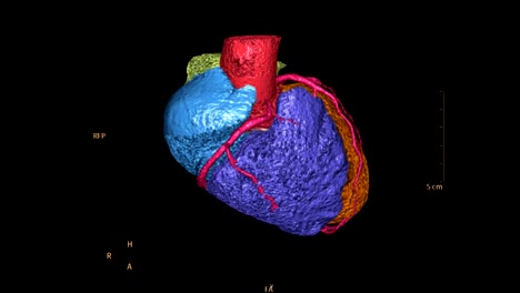 CTA-koronaren-Arterie-bunte-3D-Rendering-Bild.-CT-Angiographphy-für-Herz-Kreislauferkrankungen.