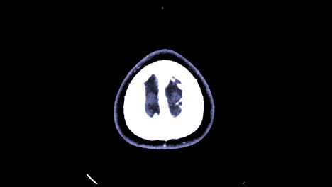 CTA-Gehirn-oder-berechnet-tomographische-Angiographie-des-Gehirns-Axial-anzeigen-/-3D-Rendering-Bild-zeigt-Schiffe-im-menschlichen-Gehirn.