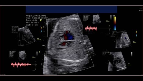 Fetal-echocardiogram