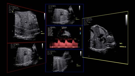 Fetal-echocardiogram