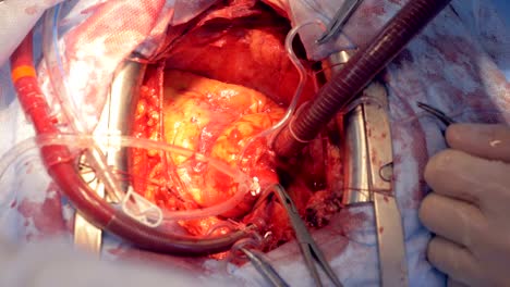 Close-up-of-a-beating-heart-during-surgery