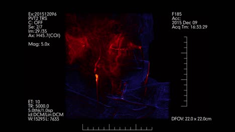 Blue-and-orange-colored-brain-vessels-angiogram.--Cerebral-angiography.