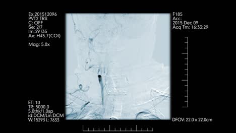 Scan-de-rayos-x-de-cabeza-de-los-vasos-sanguíneos.