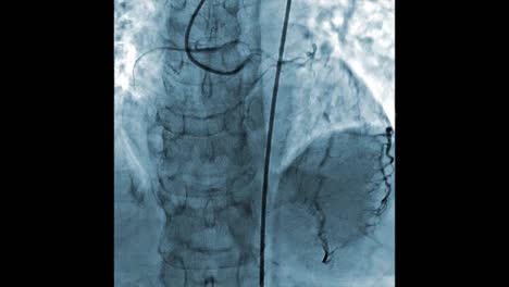 Blau-gefärbt-Angiographie-Prüfung-der-Herzgefäße