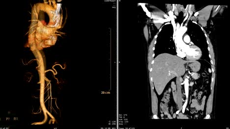 tomographische-Angiographie-(CTA)-berechnet-der-thorakalen-Aorta-3D-Rendering-Bild-VS-KORONALEN-Ebene.