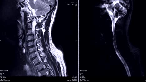 MRI-de-la-espina-dorsal-cervical-en-el-plano-sagital-con-la-médula-espinal.