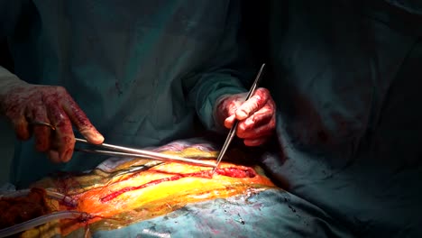 Closing-chest-after-heart-surgery-the-operation