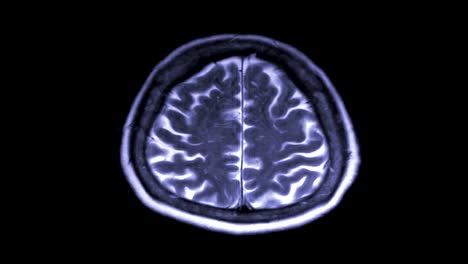 MRI-Gehirn-Scan-axialen-Blick-auf-schwarzem-Hintergrund.-Magnet-Resonanz-Tomographie.