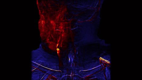 Farbige-Gehirn-Schiffe-Angiographie-|-Zerebrale-Angiographie.