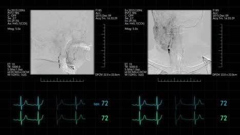 Medizinischer-Monitor-mit-Neuro-vaskuläre-Angiogramm